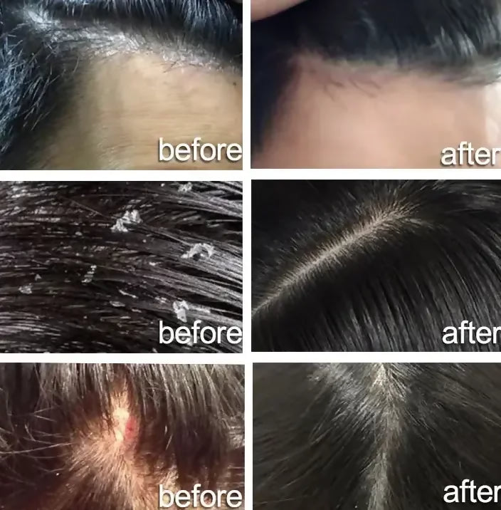 Nizol - Dandruff Shampoo